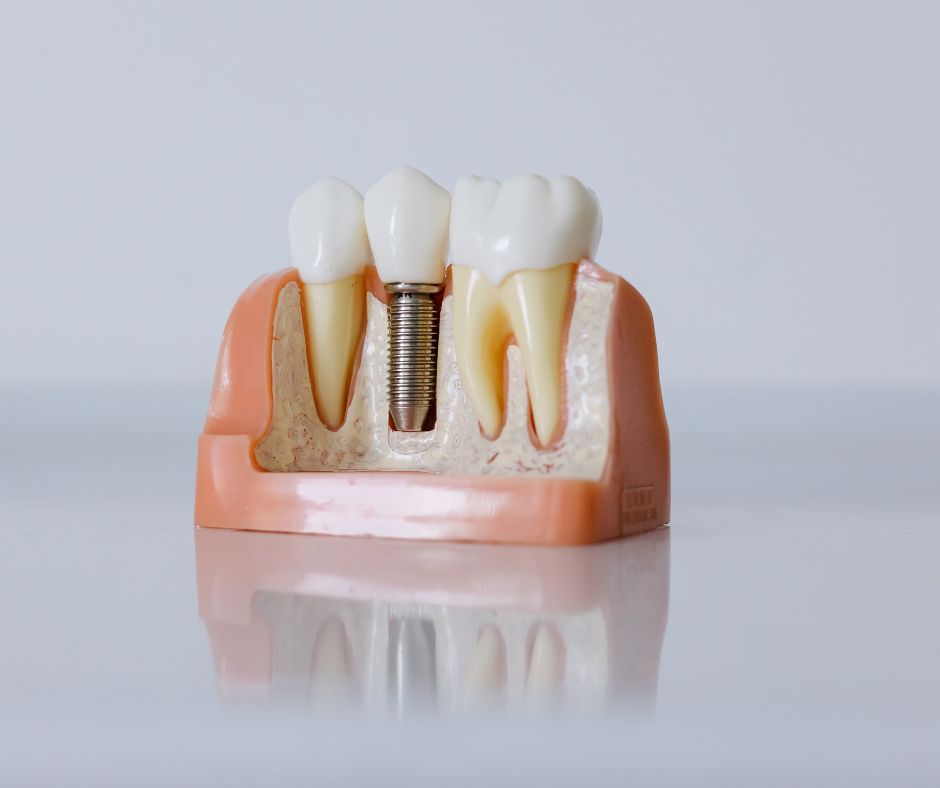 bone augmention dentistry tempe az