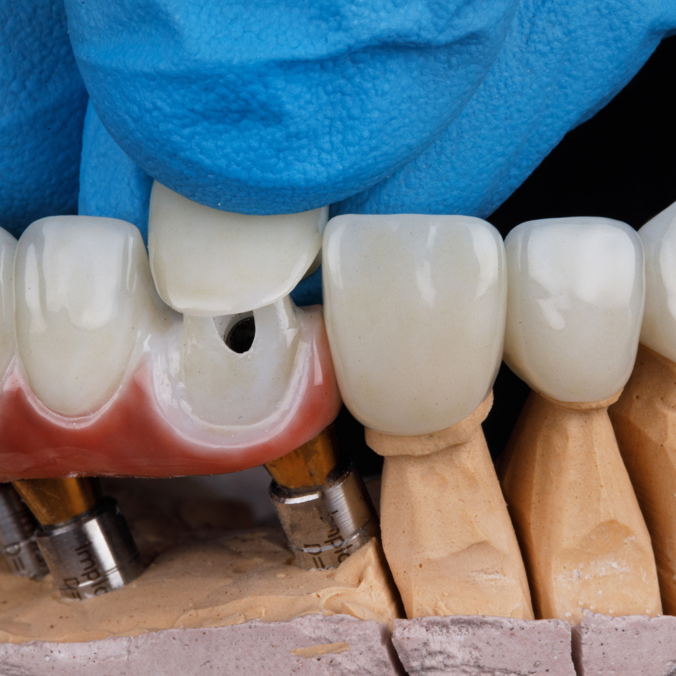 dental crowns installation