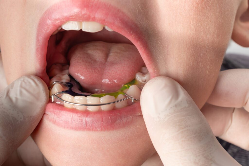 Maximize Your Retainer&rsquo;s Lifespan by Combining the Best Ultrasonic 