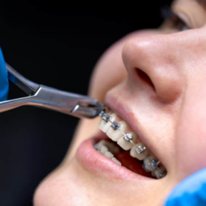 Braces Invisalign