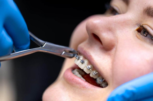 Braces Invisalign