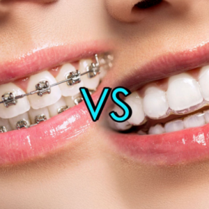 How Much Are Invisalign