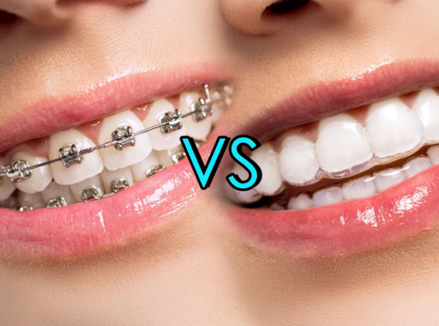 How Much Are Invisalign