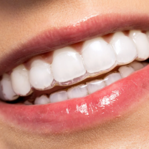 How Much Does Invisalign Cost