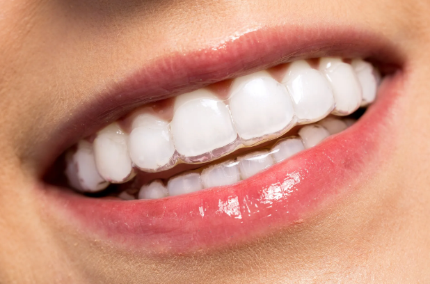 How Much Does Invisalign Cost