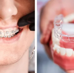 Invisalign and Braces