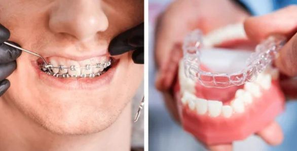 Invisalign and Braces