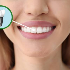 Dental Implant