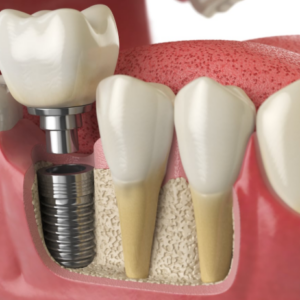 Full Dental Implants Cost