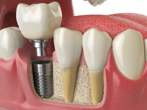 Full Dental Implants Cost