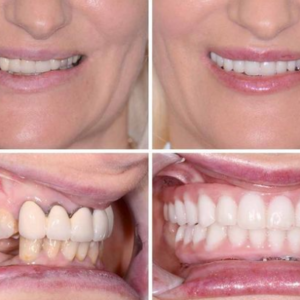 How Much Does Full Mouth Dental Implants Cost
