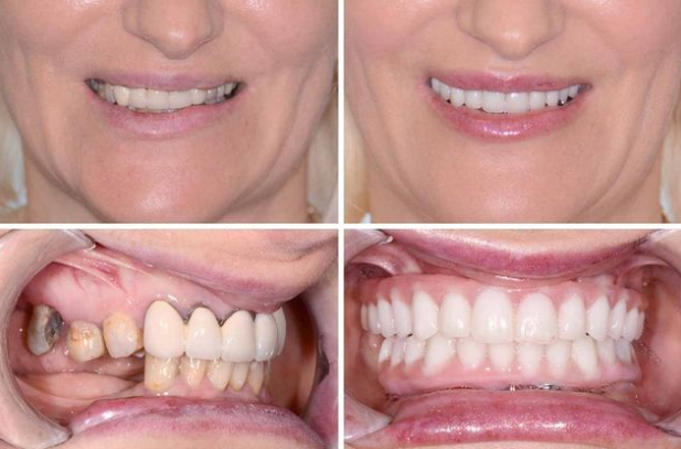 How Much Does Full Mouth Dental Implants Cost