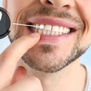 all on four dental implants