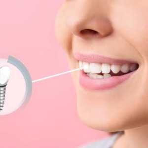 cheapest way to do an all on four dental implant